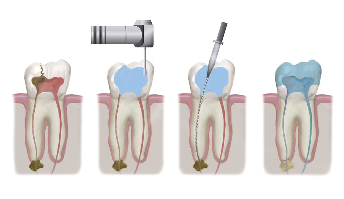 rct process