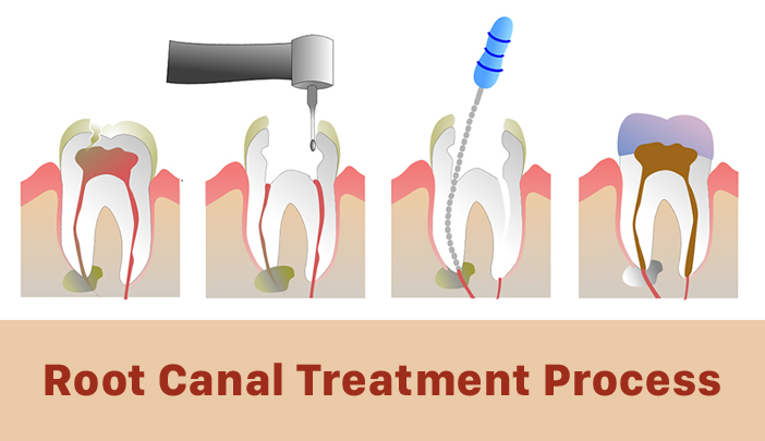 Root Canal Treatment Procedure
