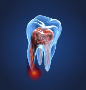 root canal services
