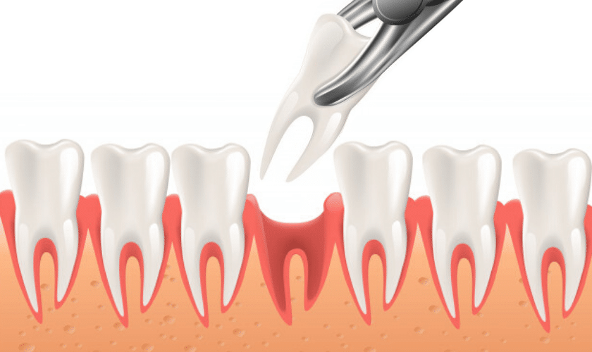 tooth extraction services