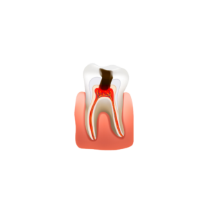 Tooth Extractions